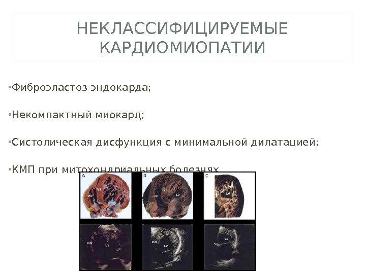 НЕКЛАССИФИЦИРУЕМЫЕ КАРДИОМИОПАТИИ • Фиброэластоз эндокарда;  • Некомпактный миокард;  • Систолическая дисфункция с