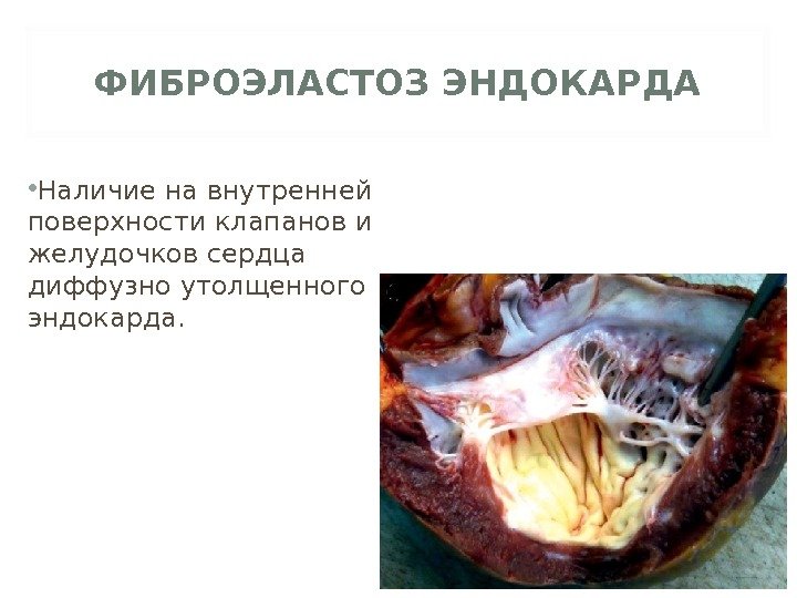 ФИБРОЭЛАСТОЗ ЭНДОКАРДА • Наличие на внутренней поверхности клапанов и желудочков сердца диффузно утолщенного эндокарда.