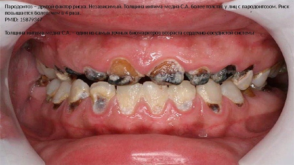 Пародонтоз – другой фактор риска. Независимый. Толщина интима-медиа С. А. более толстая у лиц