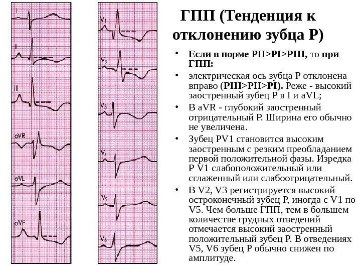 ГПП (Тенденция к отклонению зубца Р) • Если в норме PIIPIPIII,  то при