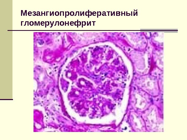 Мезангиопролиферативный гломерулонефрит 