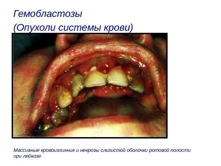 Гемобластозы (Опухоли системы крови)  Массивные кровоизлияния и некрозы слизистой оболочки ротовой полости при