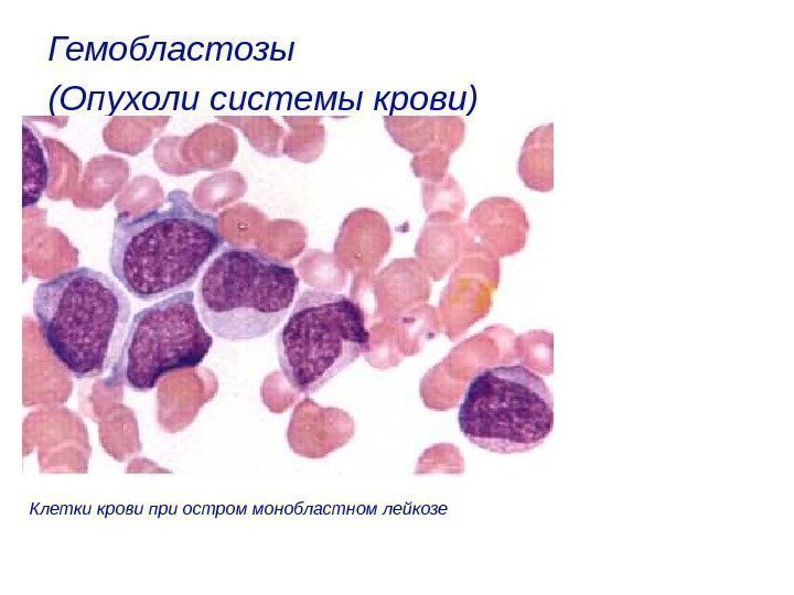 Гемобластозы (Опухоли системы крови)  Клетки крови при остром монобластном лейкозе 