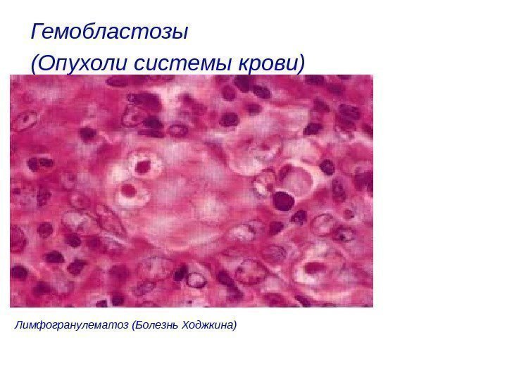 Гемобластозы (Опухоли системы крови)  Лимфогранулематоз (Болезнь Ходжкина) 