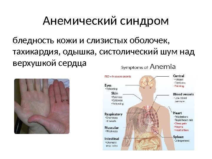 Анемический синдром бледность кожи и слизистых оболочек,  тахикардия, одышка, систолический шум над верхушкой