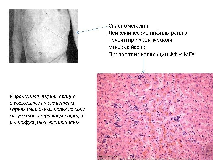 Спленомегалия Лейкемические инфильтраты в печени при хроническом миелолейкозе Препарат из коллекции ФФМ МГУ Выраженная