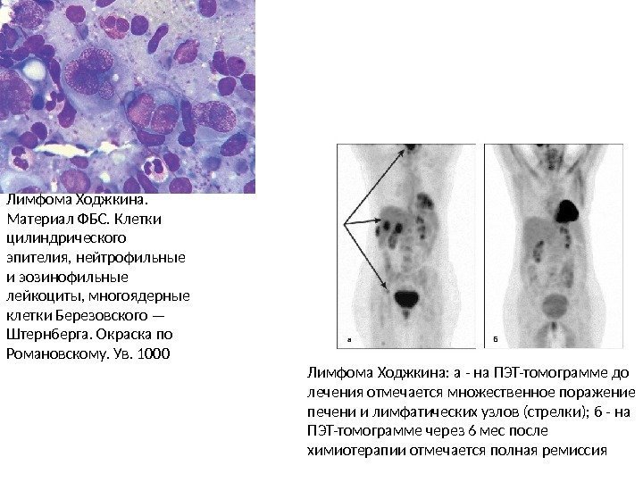Лимфома Ходжкина.  Материал ФБС. Клетки цилиндрического эпителия, нейтрофильные и эозинофильные лейкоциты, многоядерные клетки
