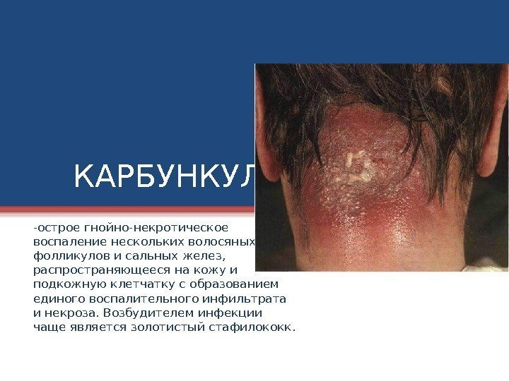 КАРБУНКУЛ -острое гнойно-некротическое воспаление нескольких волосяных фолликулов и сальных желез,  распространяющееся на кожу