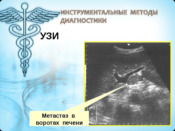 УЛЬТРАЗВУКОВОЕ СКАНИРОВАНИЕ Метастаз в  воротах печени УЗИ 