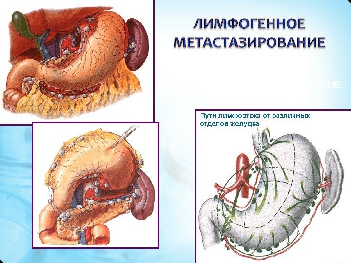 РАСПРОСТРАНЕНИЕ ПО ЛИМФАТИЧЕСКОЙ СИСТЕМЕ 