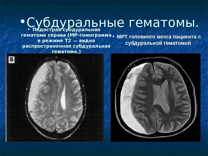  • МРТ головного мозга пациента с субдуральной гематомой  • Субдуральные гематомы. 