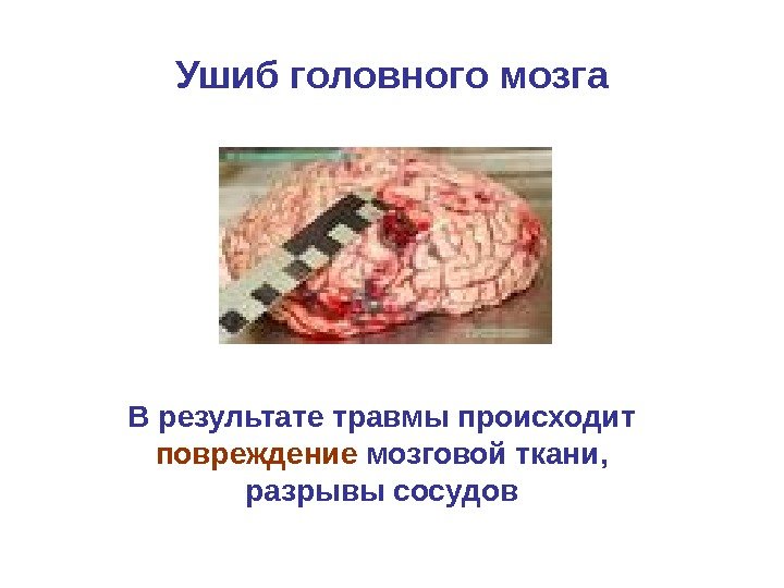   Ушиб головного мозга В результате травмы происходит повреждение мозговой ткани,  разрывы