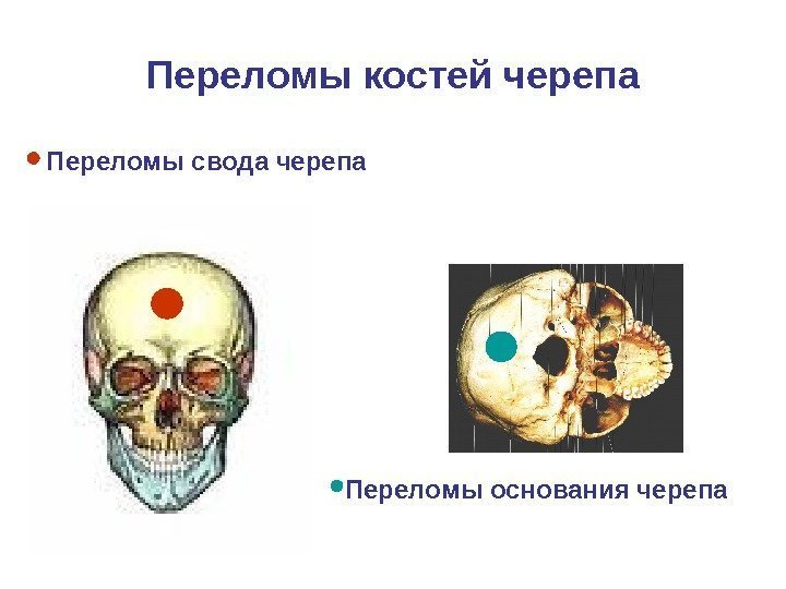   Переломы костей черепа Переломы свода черепа Переломы основания черепа 