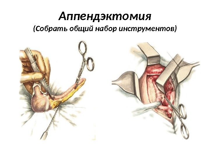 Аппендэктомия (Собрать общий набор инструментов) 