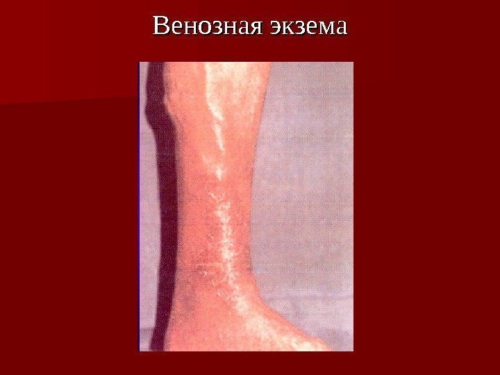 Венозная экзема 