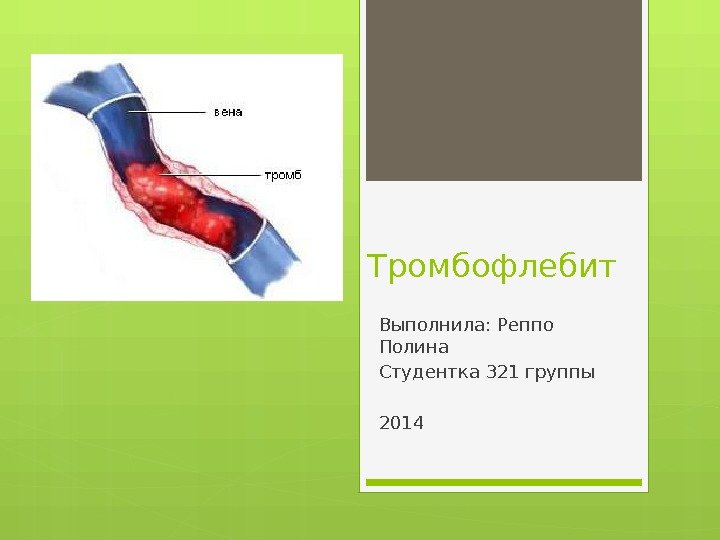 Тромбофлебит Выполнила: Реппо Полина Студентка 321 группы 2014     