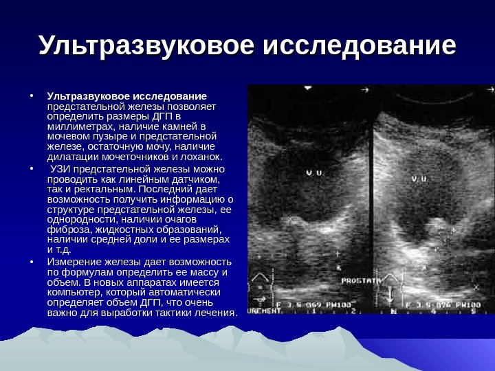 Ультразвуковое исследование • Ультразвуковое исследование  предстательной железы позволяет определить размеры ДГП в миллиметрах,