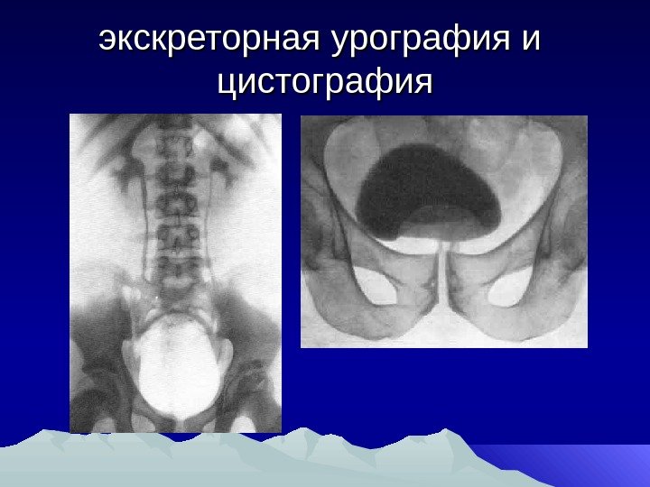 экскреторная урография и  цистография 