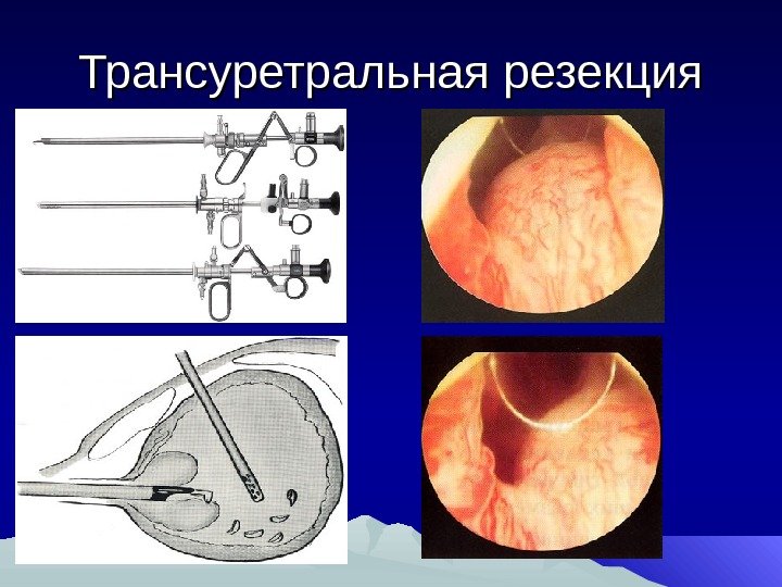 Трансуретральная резекция 