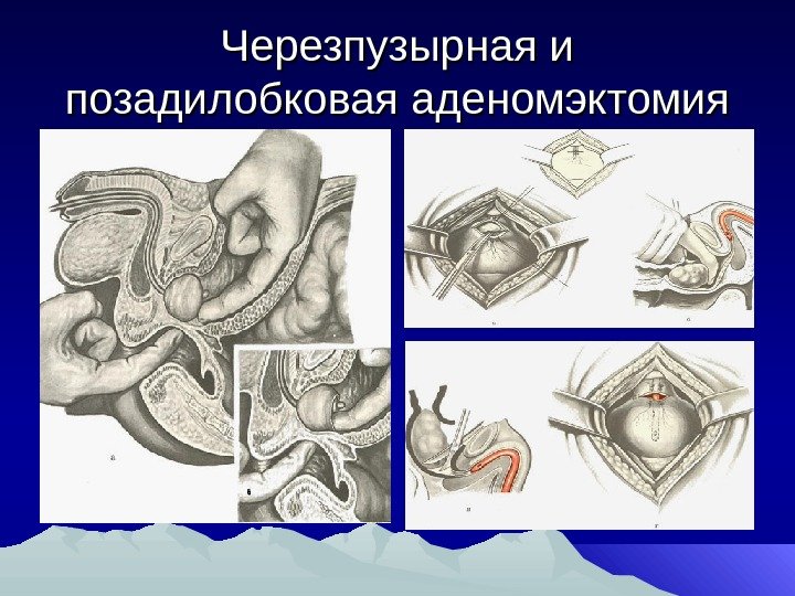 Черезпузырная и позадилобковая аденомэктомия 