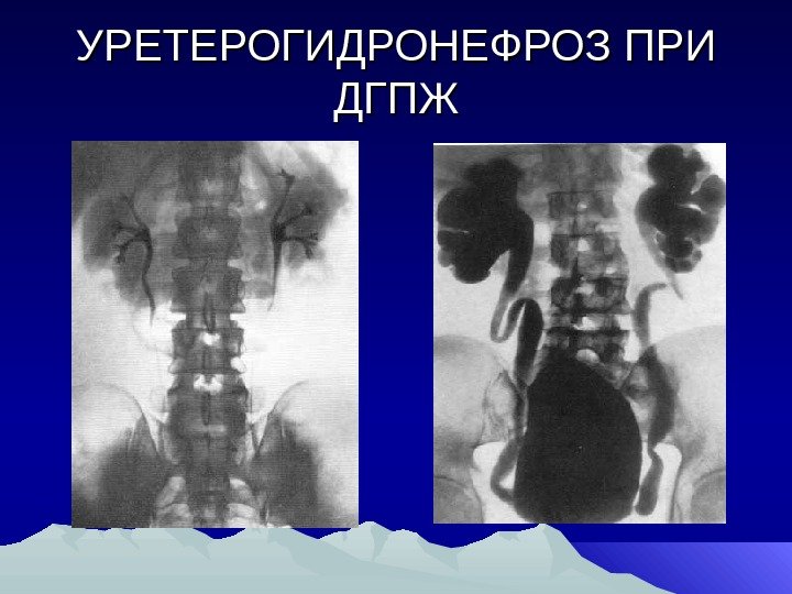 УРЕТЕРОГИДРОНЕФРОЗ ПРИ ДГПЖ 