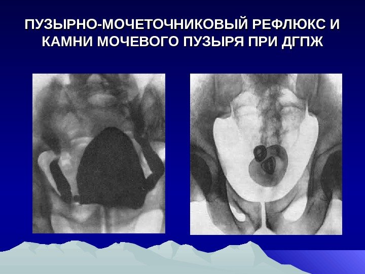 ПУЗЫРНО-МОЧЕТОЧНИКОВЫЙ РЕФЛЮКС И КАМНИ МОЧЕВОГО ПУЗЫРЯ ПРИ ДГПЖ 