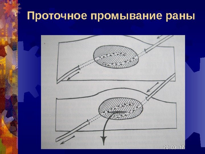 Проточное промывание раны 