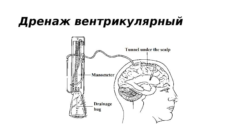 Дренаж вентрикулярный 