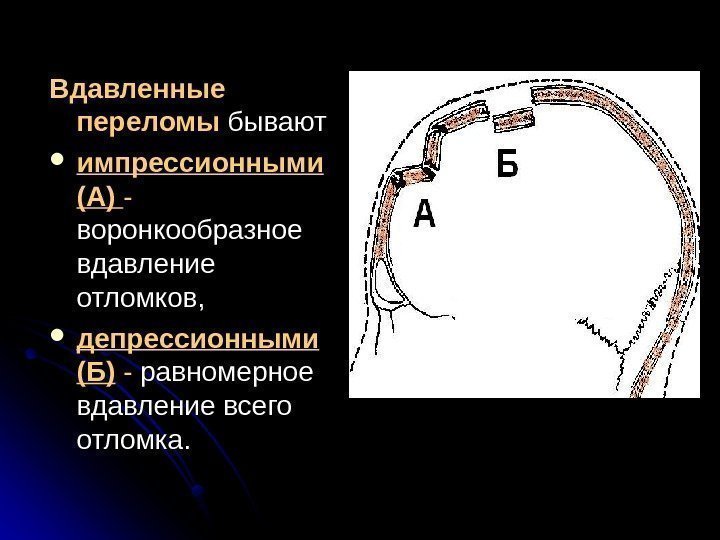   Вдавленные переломы бывают импрессионными (А)(А)  --  воронкообразное вдавление отломков, 