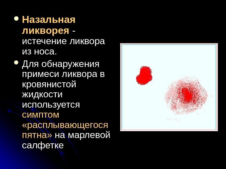   Назальная ликворея - -  истечение ликвора из носа.  Для обнаружения