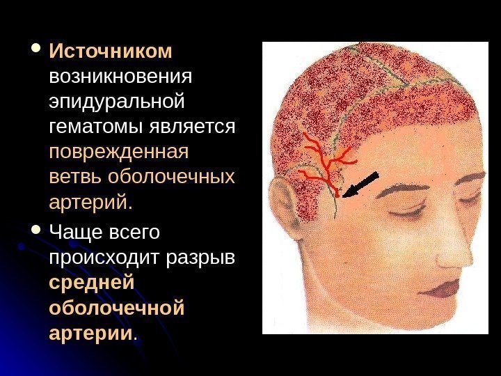   Источником возникновения эпидуральной гематомы является поврежденная  ветвь оболочечных артерий.  Чаще