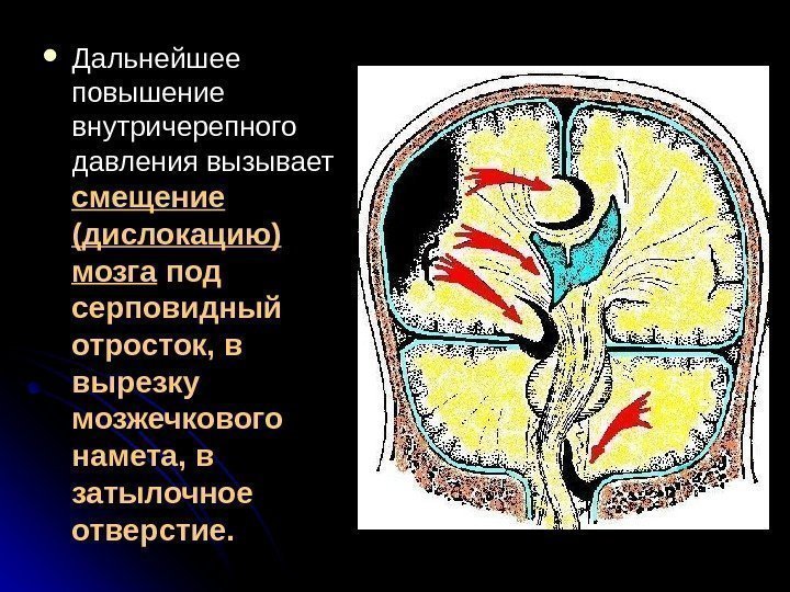   Дальнейшее повышение внутричерепного давления вызывает смещение (дислокацию) мозга под серповидный отросток, в