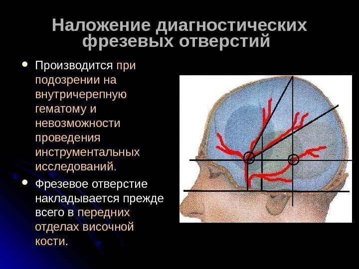   Наложение диагностических фрезевых отверстий Производится при подозрении на внутричерепную гематому и невозможности