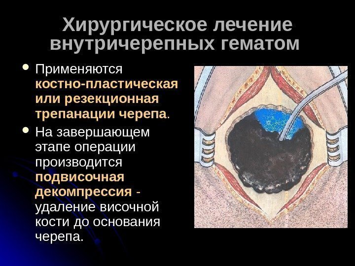   Хирургическое лечение внутричерепных гематом Применяются костно-пластическая или резекционная трепанации черепа. . 