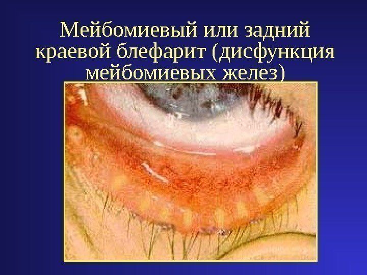 Мейбомиевый или задний краевой блефарит (дисфункция мейбомиевых желез) 