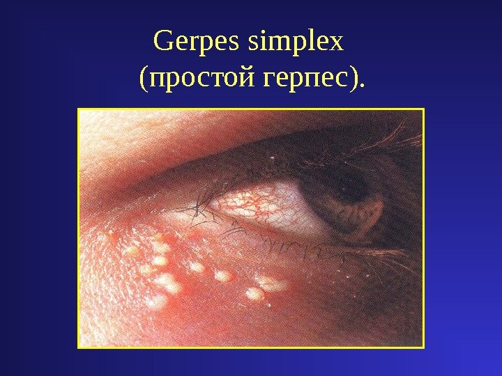 Gerpes simplex  (простой герпес). 