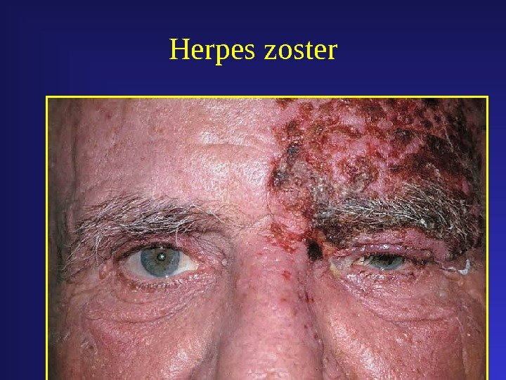 Herpes zoster 