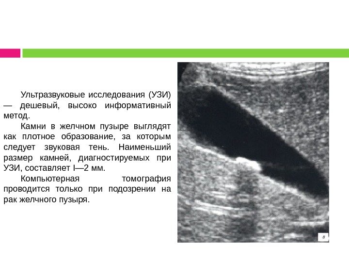 Ультразвуковые исследования (УЗИ) — дешевый,  высоко информативный метод. Камни в желчном пузыре выглядят