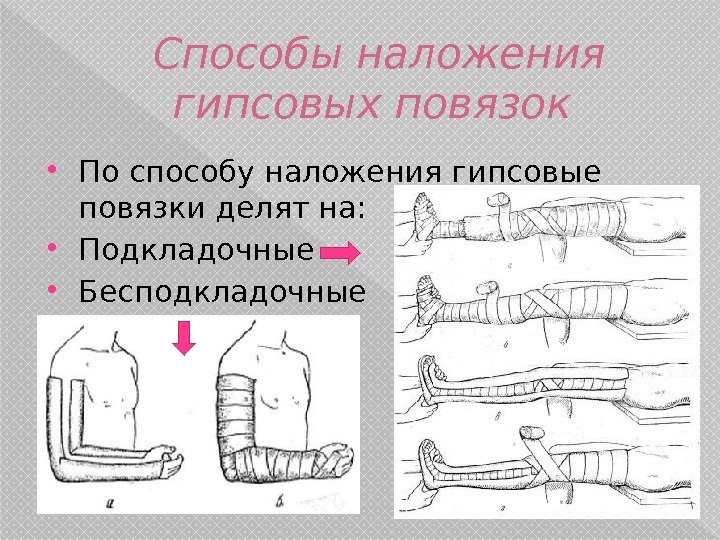 Способы наложения гипсовых повязок  По способу наложения гипсовые повязки делят на:  Подкладочные