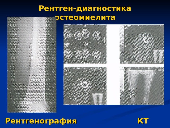   Рентген-диагностика остеомиелита Рентгенография    КТ 