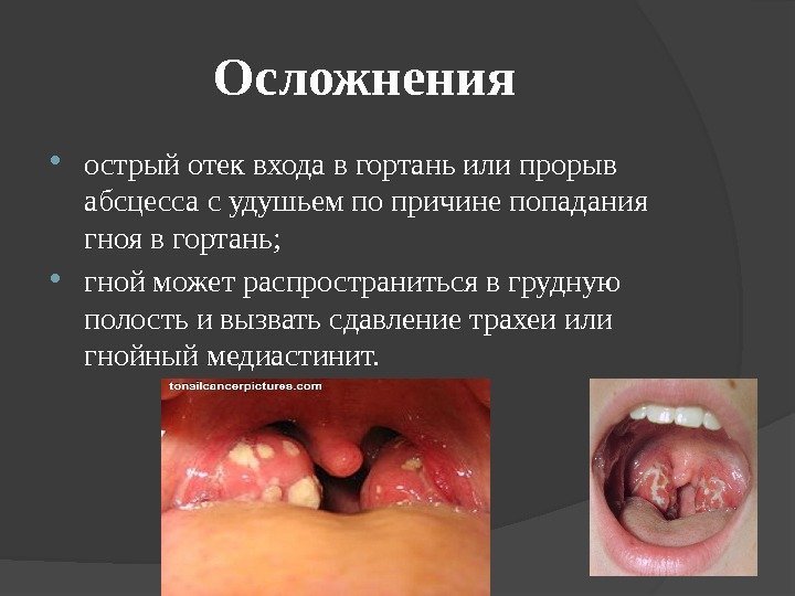 Осложнения острый отек входа в гортань или прорыв абсцесса с удушьем по причине попадания