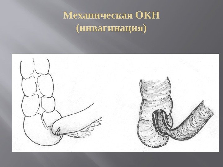 Механическая ОКН (инвагинация) 