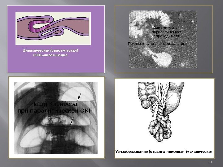 Динамическая (спастическая) ОКН. -инвагинация Полноеотсутствиеперистальтики Чаши Клойбера  при паралитической ОКН Динамическая паралитическая непроходимость