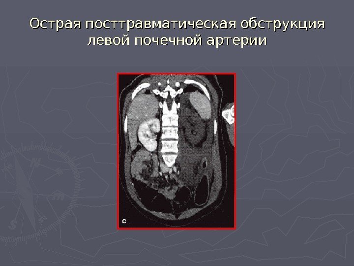   Острая посттравматическая обструкция левой почечной артерии 