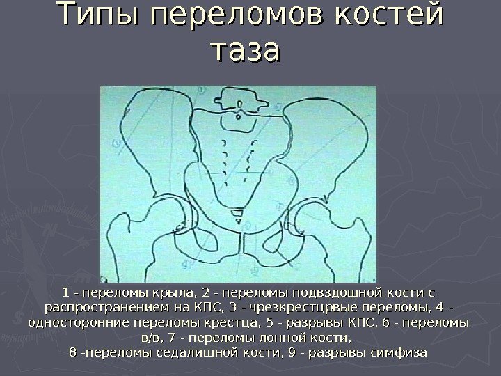   Типы переломов костей таза (( E. Letournel 1981 )) 1 - переломы