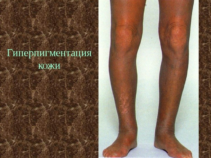 Гиперпигментация кожи 