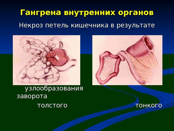 Гангрена внутренних органов Некроз петель кишечника в результате    узлообразования  