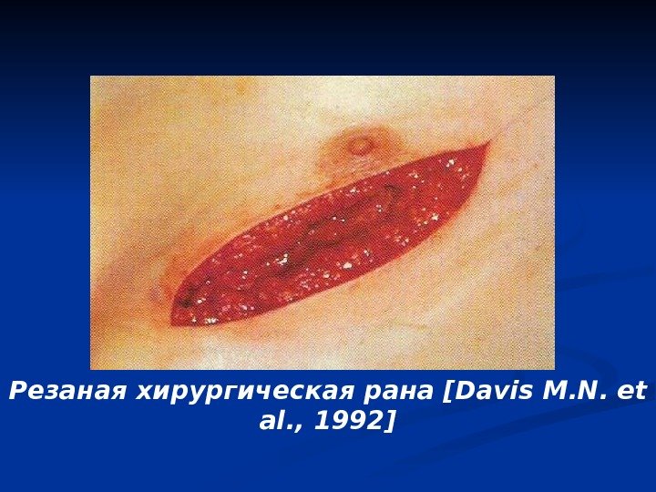 Резаная хирургическая рана [Davis M. N. et al. , 1992] 
