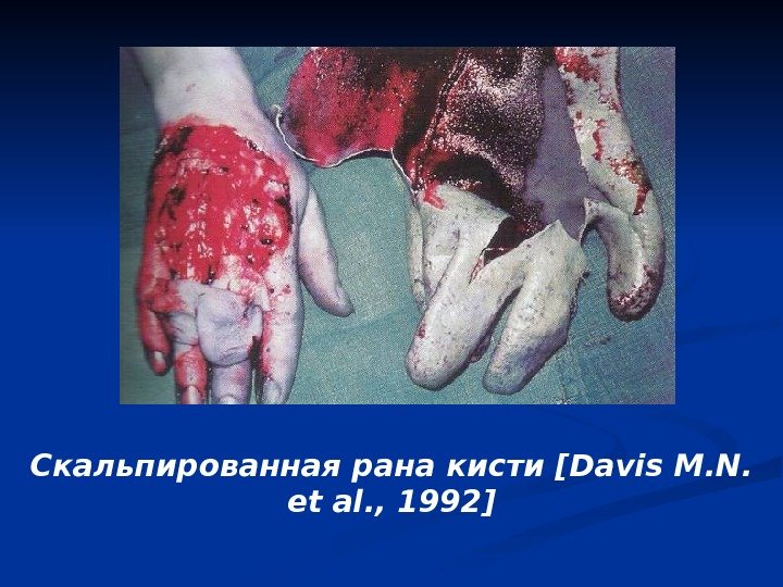 Скальпированная рана кисти [Davis M. N.  et al. , 1992] 