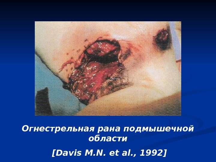 Огнестрельная рана подмышечной области  [Davis M. N. et al. , 1992] 